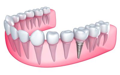 Dental Implants – The Pros and Cons
